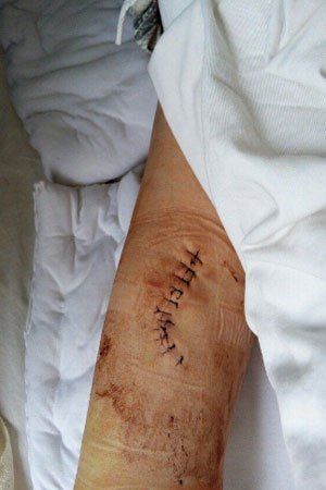 被刀捅的伤口照片图片